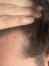 M22 1 month topical minox/fina