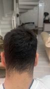 What is my approximate norwood level?