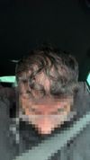 23M, 12 Months After 4500 Graft Transplant, No Minoxidil/Finasteride - Next Steps?