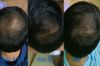 2 months progress on fin 1mg