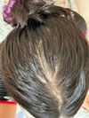 29F Seeking Advice for Severe Hair Loss and Bald Patches