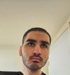 20-Year-Old Seeking Advice on Diffuse Thinning and Treatment Options