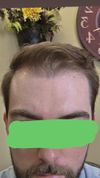 27M Best option for my current hair? Shave? Is HT possible?