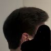 19M: Hair Thinning After 5 Months on Finasteride &amp; Minoxidil, Need Advice