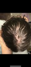 Trying to identify area of treatment with topical fin