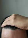 Is there a chance to regrow hairline or are those folicules gone?