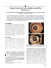Hypertrichosis of the Eyelashes Caused by Bimatoprost