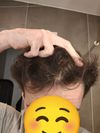 4.5 Month Progress (20M) – Can I expect more density and hairline regrowth?