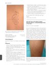 Acute Hair Loss on the Limbs in Frontal Fibrosing Alopecia: A Clinicopathological Study of Two Cases