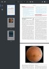 Macular Burn Secondary to Diode Laser Epilation