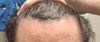 Do I need Finasteride?