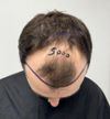 4-Month Hair Transplant Progress: 5120 Grafts with Dr. Ahmet Yildirim