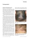 Clinical Study of Fibrosing Alopecia in a Pattern Distribution in a Latin American Population
