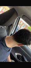 Hair Transplant Recommendations Within $3000 Budget