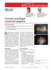 Central Centrifugal Cicatricial Alopecia