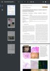 Concentrated Growth Factor Therapy as Cosmetic Treatment in Discoid Lupus Erythematosus