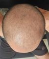 Can i have good results with a hair transplat + dutasteride + oral minoxidil?