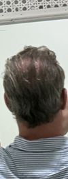 Should I Continue Comb-Over After Hair Transplant?