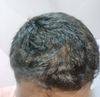 20M with Receding Hairline and Thinning at Crown, Minoxidil 5% for 15 Days - Need Advice on Norwood Stage and Treatment Steps