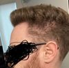 What kind of balding is this?
