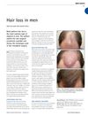 Hair Loss in Men: Causes and Treatments