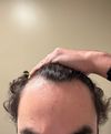 M20 with Hair Loss - Clascoterone an Option?