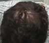 Thinning in Hairline and Vertex - What do I do?
