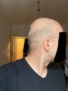Treatment advice on balding with different hair colors