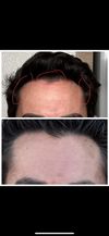 Been on Finasteride for 20 years. Recently started noticing some thinning near my temples. Unsure what to do next