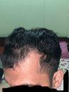 26M with 2 Years of Minoxidil &amp; Microneedling, Hairline Worsening, Need Advice on Finasteride