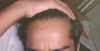 18, Considering Buzz Cut for Low Density Hair and Visible Hairline