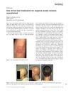 One of the Best Treatments for Alopecia Areata Remains Unpublished