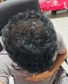 25M: Switched from Finasteride to Dutasteride After 1 Month; Is This Normal?