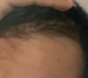 22M on Minoxidil 2yrs, Finasteride 1wk: Can I Improve Hairline Density?