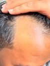 27M: Considering Oral Finasteride with 5% Minoxidil &amp; Microneedling - Advice?