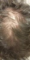 Is been 4 months since taking minoxidil .50 miligrams and i think i see changes