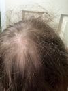 21M with Thinning/Receding Hair Since 18: Is Treatment Worth It?
