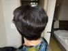 Conflicted Diagnoses: Is My Hair Loss MPB Despite Using Finasteride and Rogaine?