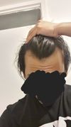 22M Considering Finasteride: Receding Hairline Concerns and Stability
