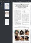 Topical Ruxolitinib in Combination with Oral Minoxidil Results in Hair Regrowth in a Patient with Central Centrifugal Cicatricial Alopecia and Concomitant Traction Alopecia