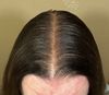 48M on Finasteride for 17 Years: Now Thinning at Crown, Considering Transplant Options