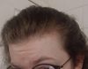 M19 Experiencing Sudden Thinning at Temples, Considering Finasteride for 7 Months