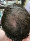 3 Months on Finasteride with Side Effects - Should I Switch to Dutasteride?