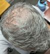 41M with Rapid Crown Loss: Should I Start Finasteride 1mg or .5mg with Minoxidil?
