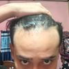 18M, 8 Months on Minoxidil &amp; Finasteride, Considering Dermaroller for Hairline Regrowth