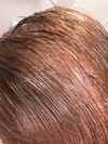 28M - Hair and Treatment Concerns