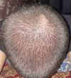 18M: Thinning at 17, Hair Loss Concern on Back and Sides, Inflammation Question