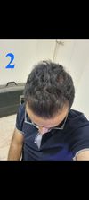Considering Switching to Dutasteride at 27 After 2.5 Years on Fin and Minoxidil
