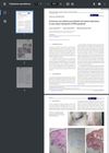 Cutaneous Sarcoidosis Post Platelet-Rich Plasma Injections: A Case Report During The COVID Pandemic