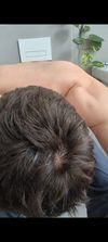 Brutal shedding after switching to oral min